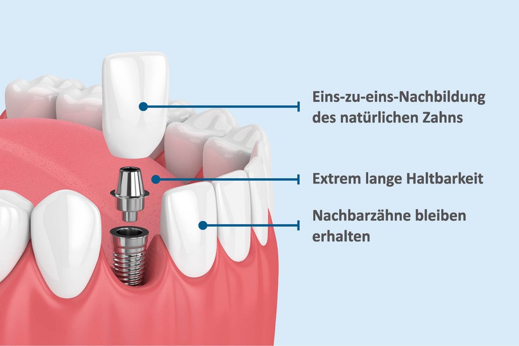 Zahnimplantat M Nchen Im Alldent Implantatzentrum